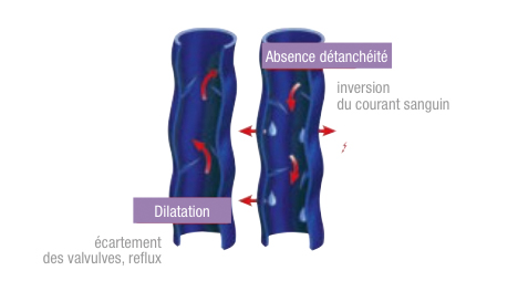 Thrombose symptomes jambe