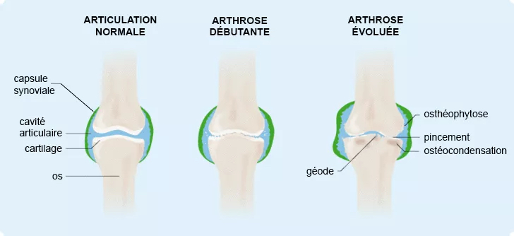 Arthrose du genou