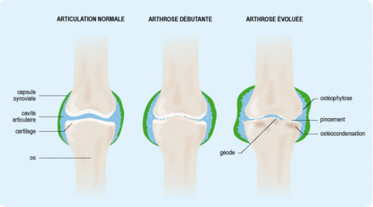 Oa Genouillère pour arthrite Ligament à charnière Support de genou Arthrose  Articulation du genou Déchargement sportif